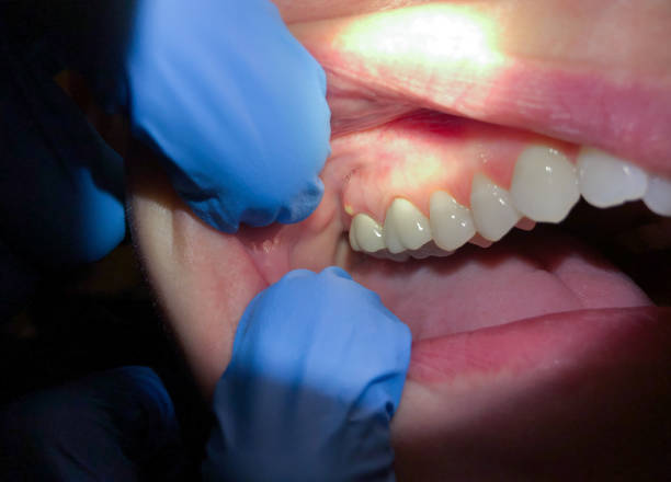 Best Emergency Treatment for Dental Infections or Abscesses in West End, NY